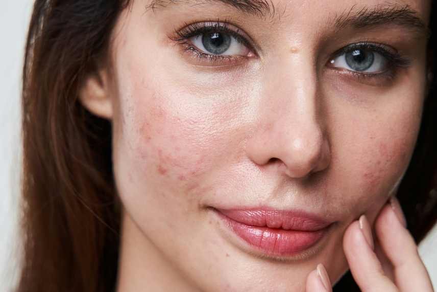 A closeup of a young woman's face showing signs of the skin condition rosacea. A Detox Lifestyle helps to reduce the redness and increase brighter skin.